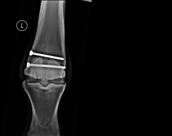 Fracture of the cannon bone just above the fetlock which has been treated with screws
